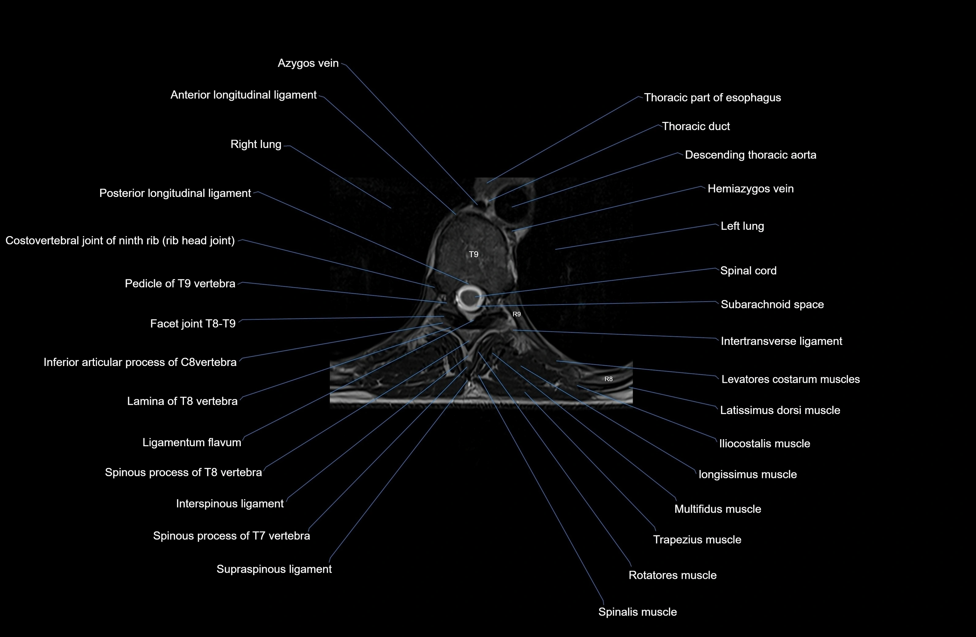 MRI thoracic spine axial  cross sectional anatomy 3T radiology  image-img-00001-00057.webp